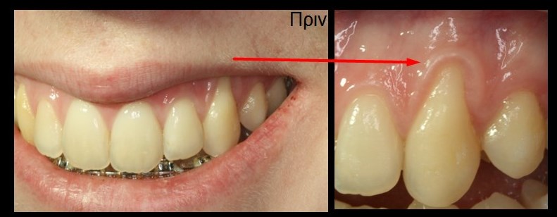 Υποχώρηση ούλου από τραυματικό βούρτσισμα 